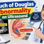 Pouch of Douglas Abnormality on Ultrasound